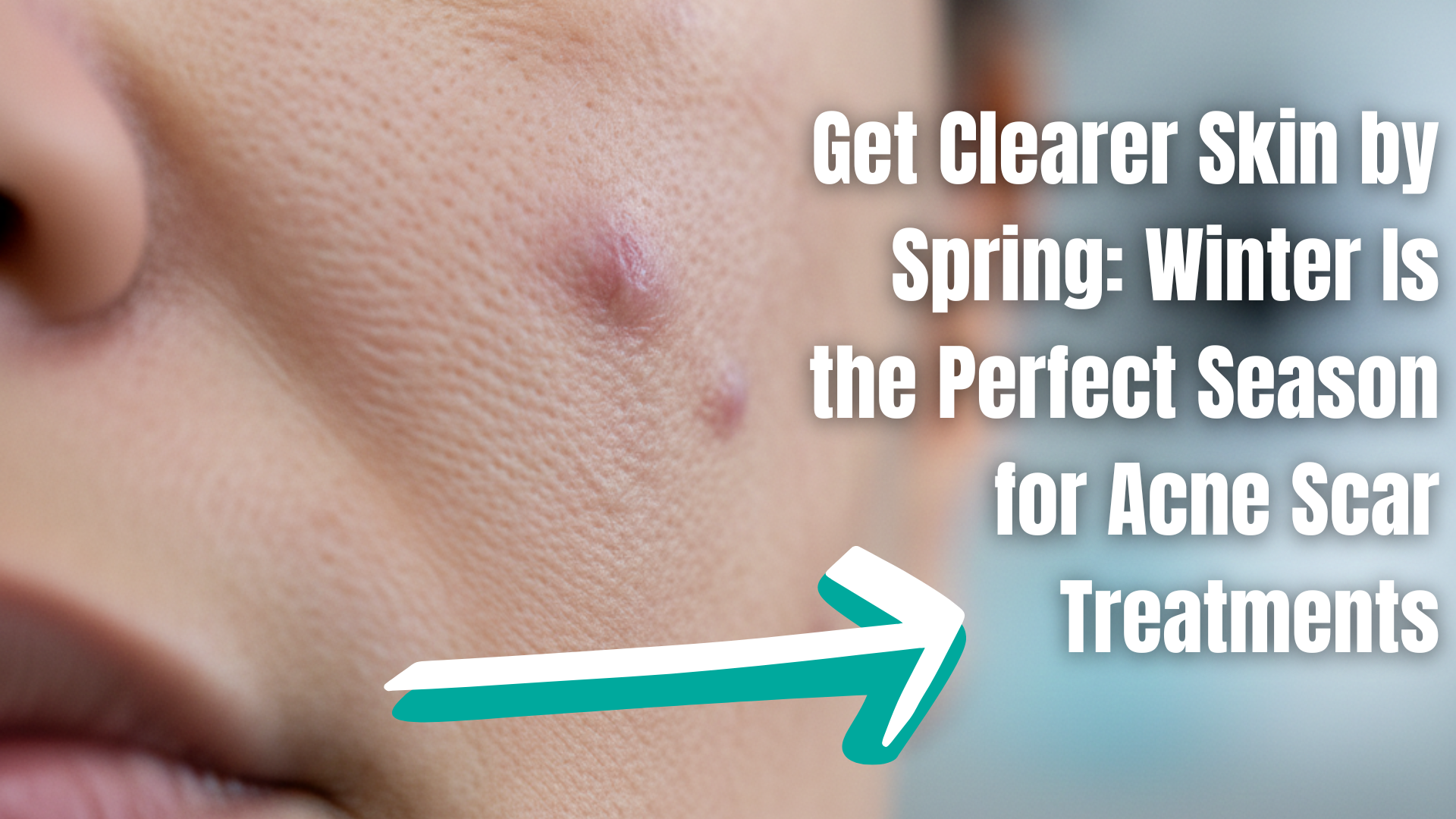 Acne Scar Treatment in Thane