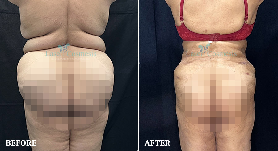 Tummy Tuck Before & After Results | Dr. Medha Bhave
