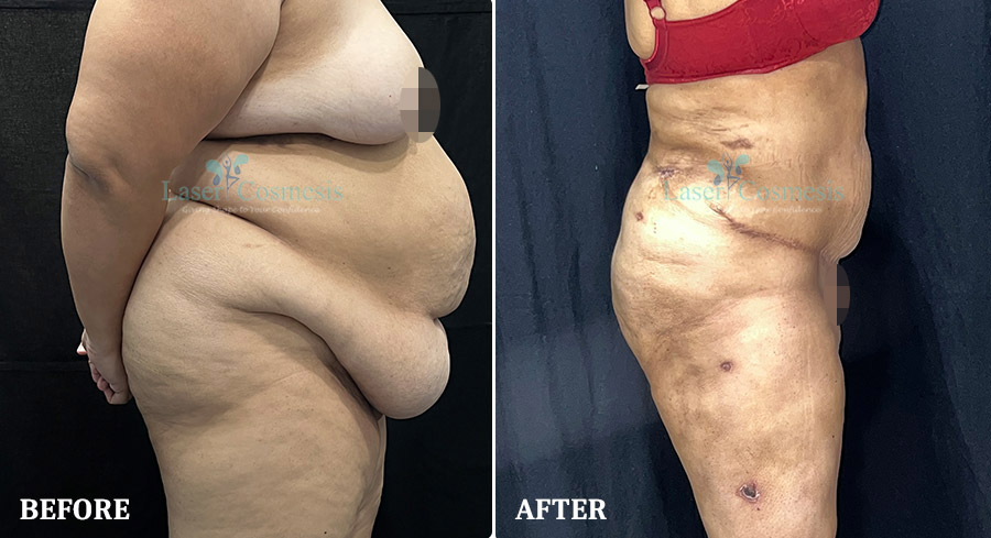 Tummy Tuck Before & After Result in Andheri