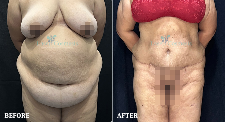 Tummy Tuck Before & After Result in Thane