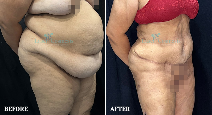 Tummy Tuck Before & After Result | Lasercosmesis