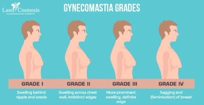 Gynecomastia Grades: Understand the severity with grades, ranging from mild to severe. Explore treatment options at LaserCosmesis for optimal results.