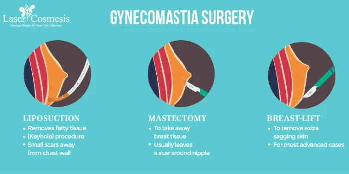 Gynecomastia Surgery: Available options are liposuction, mastectomy, and breast lift for effective Gynecomastia Surgery in Thane, Mumbai at LaserCosmesis. 